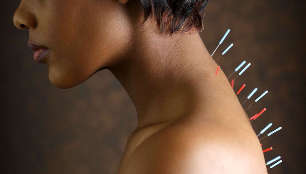 Akupunktura sa cervikalnom osteohondrozom