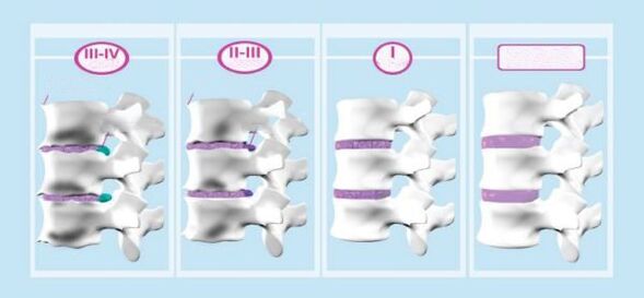 Faze cervikalne osteohondroze