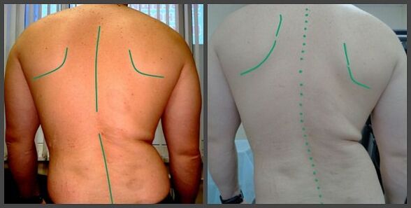 zakrivljenost kralježnice s osteohondrozom