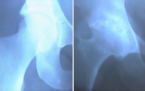 Ocjena artrozi zgloba koljena