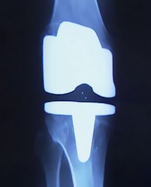 X -Ray Slika koljena sa umjetnom protezom nakon operacije za promjenu spoja